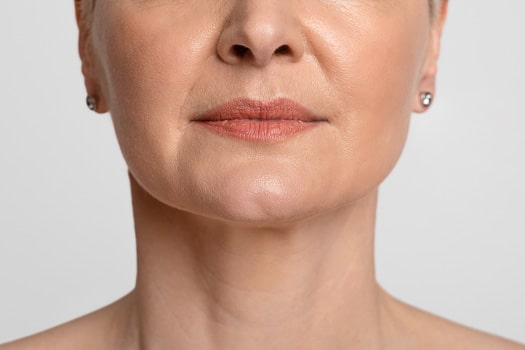 Bigode chinês: o que você precisa saber como tratar e prevenir essas marcas