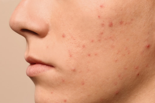 Quais os melhores tratamentos médicos estéticos para acne?