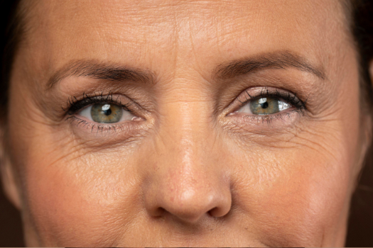 Quais os melhores tratamentos estéticos para bolsas nos olhos?